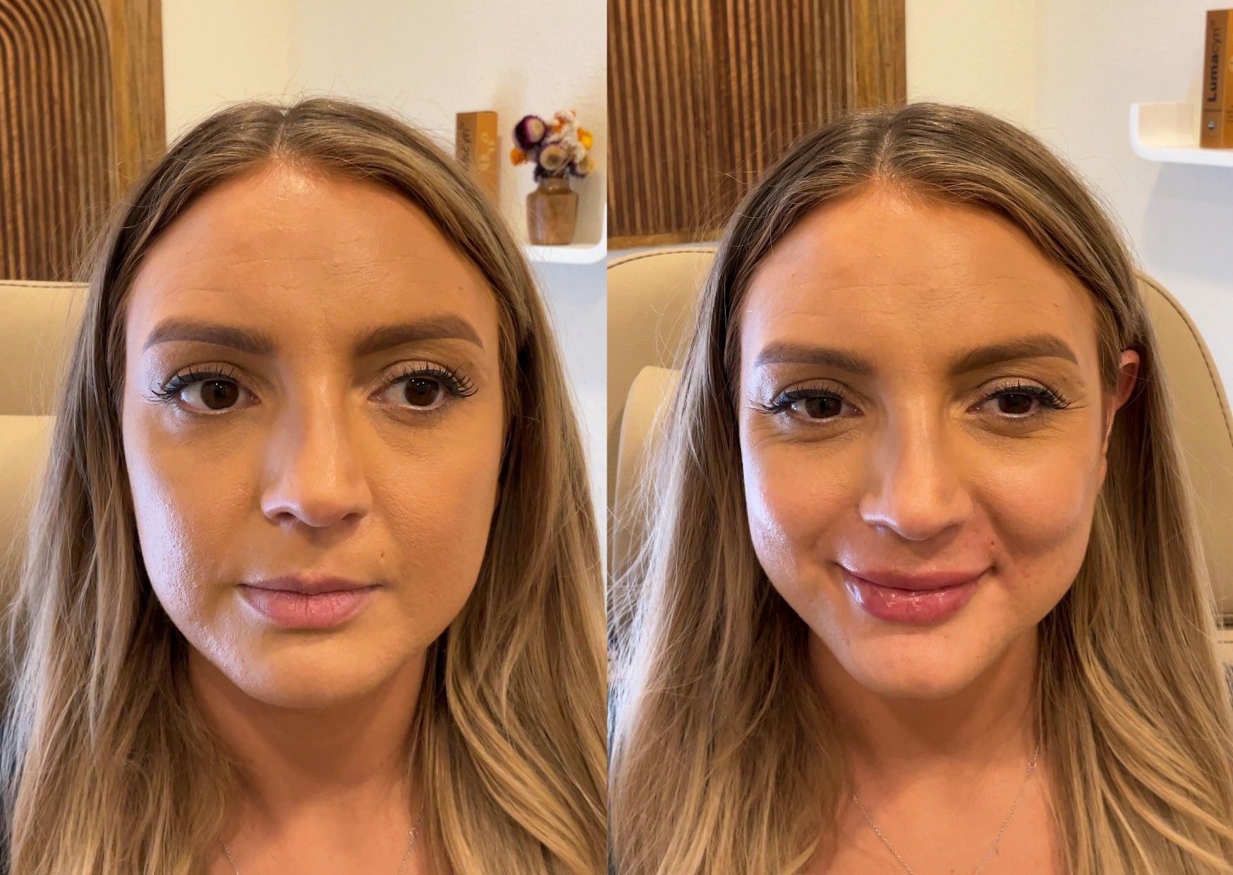 Lip Filler - Before & After